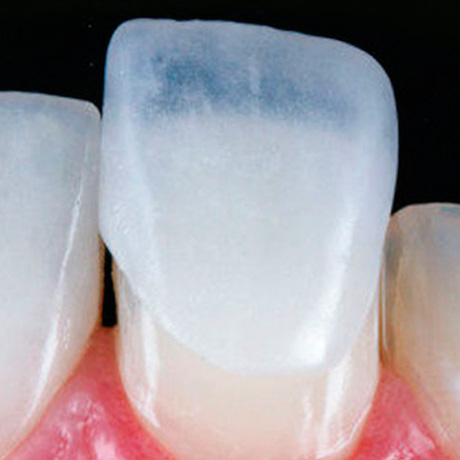 Lentes de Contato dentária