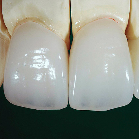 Facetas de Porcelana